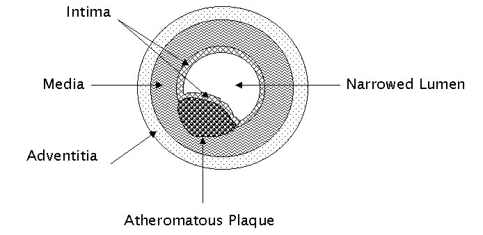 AtheromatousPlaquejpg.jpg (42162 bytes)